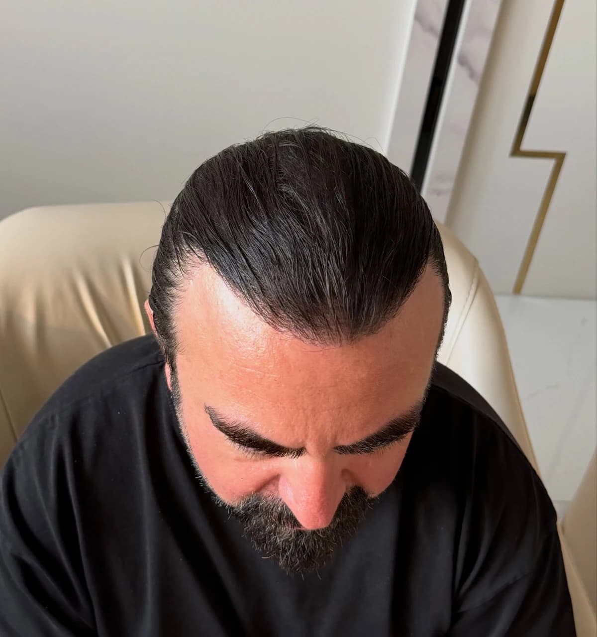 Frontal hair transplant — After