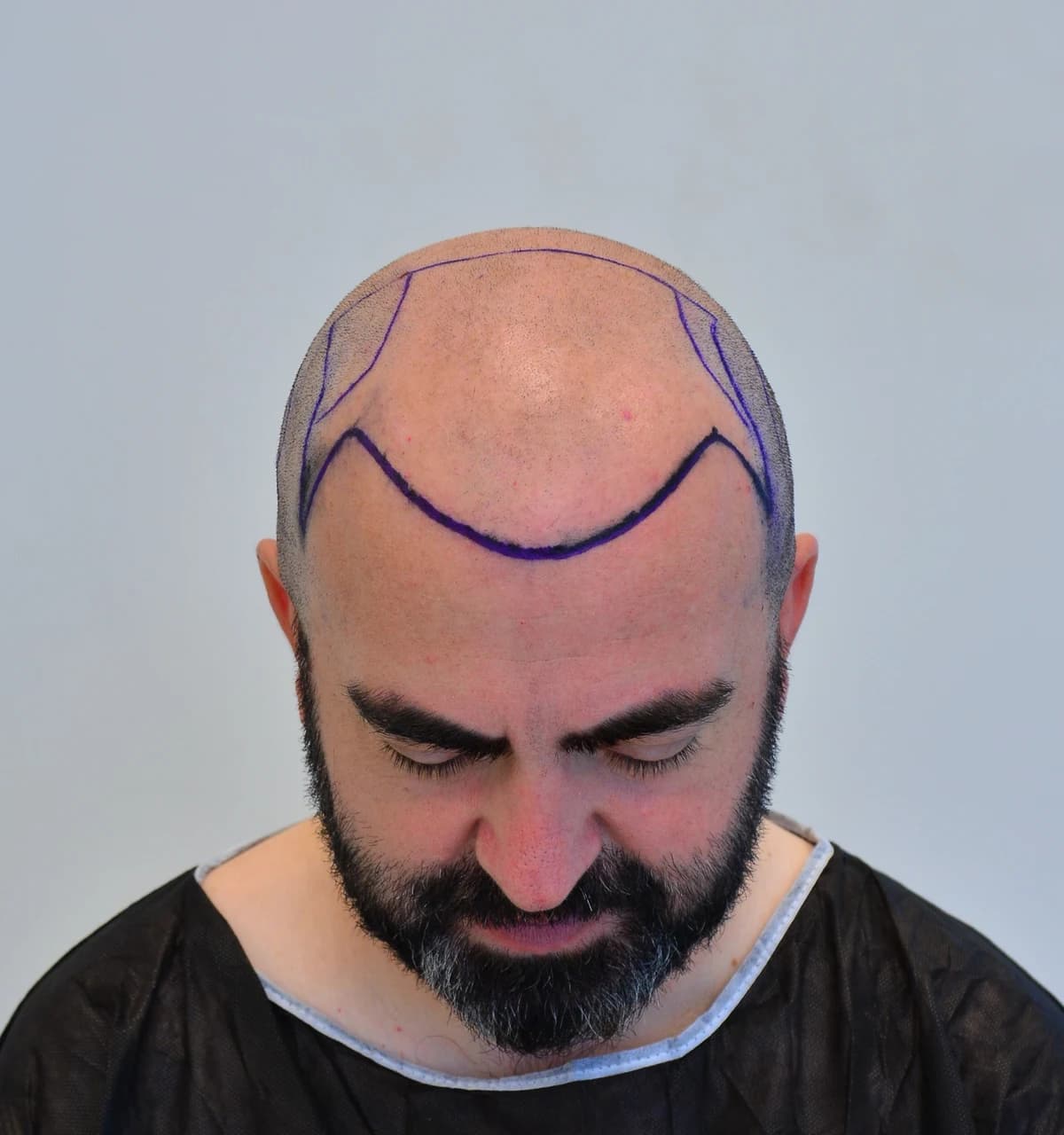 Frontal hair transplant — Before