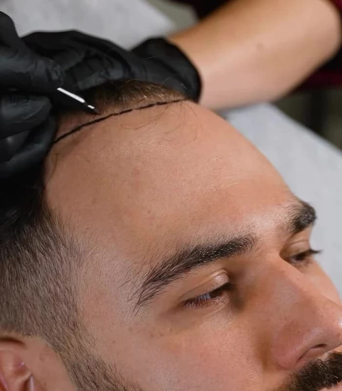 Hairline planning at Capilora clinic